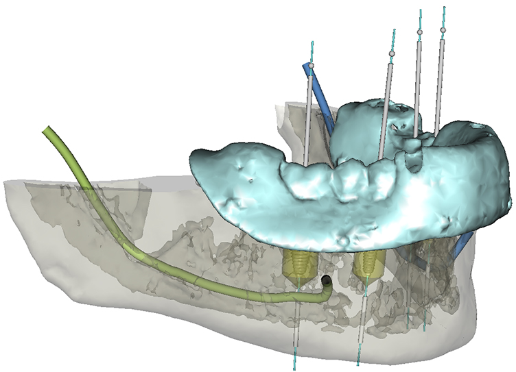 3D-Implantologie/Sofortimplantate/All-on-4
