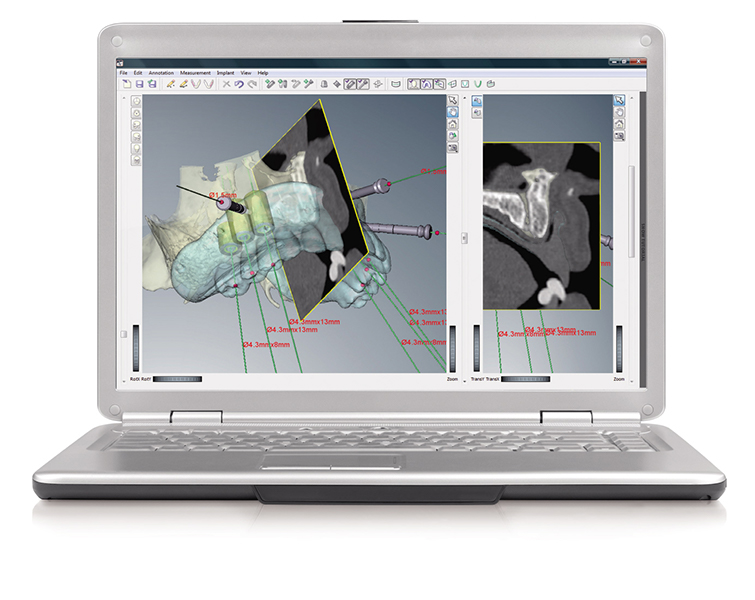 3D-Implantologie/Sofortimplantate/All-on-4