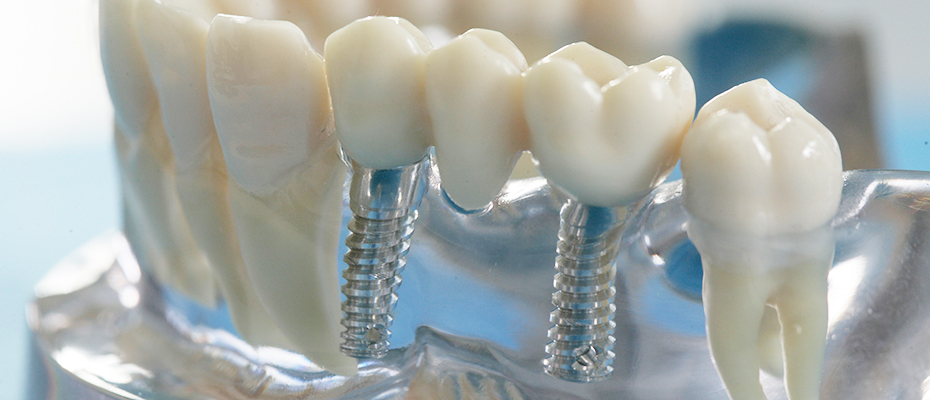 Zahn­implantate